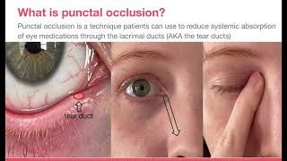 Punctal Occlusion [upl. by Floria]