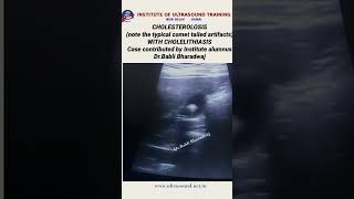 Cholesterolosis with cholelithiasis ultrasound ultrasoundlife pocus [upl. by Tertias]