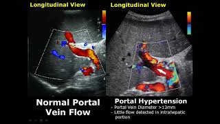 Liver Ultrasound Normal Vs Abnormal Image Appearances Comparison  Liver Pathologies USG [upl. by Ohploda]