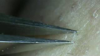 2 Inches of ingrown knee hair [upl. by Noivart522]