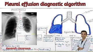 pleural effusion  approach  diagnostic algorithm  in Hindi [upl. by Perr956]