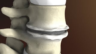 Degenerative Disc Disease Spondylosis explained by Spine Surgeon Dr Jessica Shellock Plano TX [upl. by Niamjneb162]