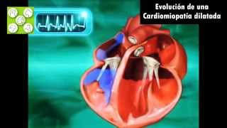 EL CORAZÓN PATOLÓGICO La Cardiomiopatía Dilatada CMD Aparición y evolución [upl. by Montano574]