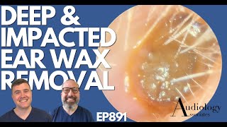 DEEP amp IMPACTED EAR WAX REMOVAL  EP891 [upl. by Sualk]