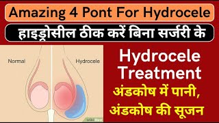 Hydrocele treatment  हाइड्रोसील ठीक करें बिना सर्जरी के  Treat Hydrocele with Naturally [upl. by Colas]