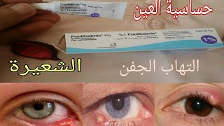 مرهم للعين 👍علاج التهاب العين والتعفنات والشعيرة👀 [upl. by Dafna]