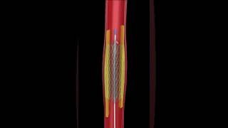 THE ULTIMATE ANGIOPLASTY ANIMATION  SEE HOW ITS DONE UP CLOSE [upl. by Dee588]