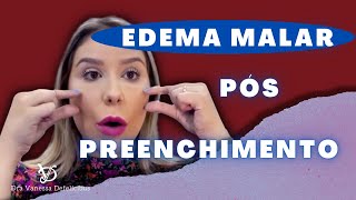 Edema malar pós preenchimento facial Causas e consequências [upl. by Eignat]