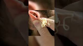 Vidéo ASMR  Élimination de Boutons Géants 🎧👌blackheads acne ytshorts [upl. by Ymeon]