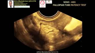 SonoHSG transvaginal ultrasound tes uji patency tuba [upl. by Lasyrc]