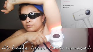 HOW I DO AT HOME LASER HAIR REMOVAL  BOSIDIN LASER HAIR REMOVAL DEVICE [upl. by Ettezus]