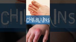 How to avoid Chilblains shorts [upl. by Nairred]