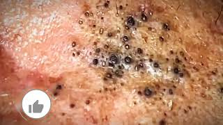 Most Satisfying CloseUp Blackhead Removal 2024 [upl. by Orvah]