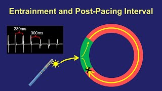 Entrainment Mapping The PostPacing Interval [upl. by Neiv]