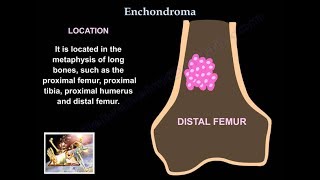 Enchondroma  Everything You Need To Know  Dr Nabil Ebraheim [upl. by Seek]