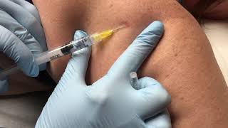 Punch Skin Biopsy  Skin Cancer Test [upl. by Lyndel]