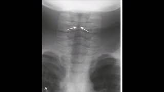 Bacterial tracheitis [upl. by Bixby911]