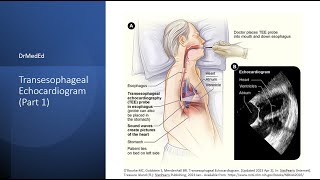 Transesophageal Echocardiogram TEE Indications and Contraindications [upl. by Hump]