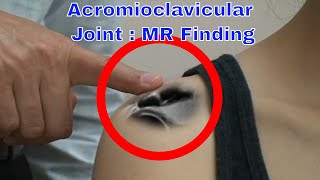 Acromioclavicular Joint  MR Finding [upl. by Notneuq]