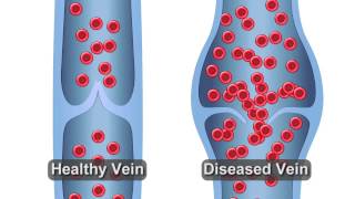 Healthy vs Diseased Vein [upl. by Nostrebor]