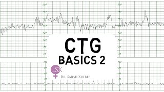 CTG Basics Part 2  Decelerations amp Fetal Physiology [upl. by Aldred]