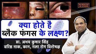 Coronavirus MucormycosisBlack Fungus Symptoms in Hindi Dr Abhay Kumar Singh SrENT Consultant [upl. by Dlanar]