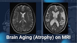 Brain Atrophy on MRI [upl. by Adrea]