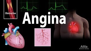 Angina Stable Unstable Microvascular and Prinzmetal Animation [upl. by Argyres416]