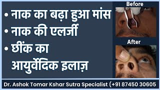 Nasal polyp नाक का बढ़ा हुआ मासनाक बंद से है परेशान आयुर्वेदा मे है स्थाई समाधानnasalpolyp [upl. by Juno]