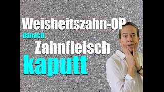 WeisheitszahnOP Zahnfleisch hängt jetzt FALSCH am ZAHN [upl. by Odnala]