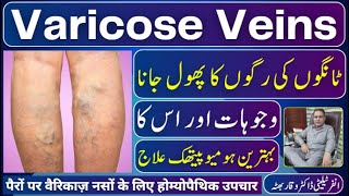 Varicose Veins رگوں کا پھعل جانا वैरिकाज वेंस Homeopathic Treatment By Dr Waqar Bhutta In Urdu Hindi [upl. by Lac941]