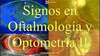 Signos en Oftalmología y Optometría Parte II [upl. by Ruprecht]