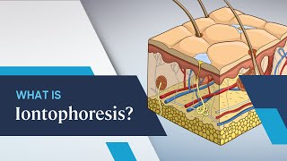 What is Iontophoresis [upl. by Weihs]