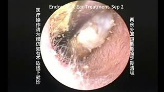 Re examination and cleaning of two cases of cholesteatoma [upl. by Elolcin861]