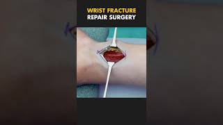 Wrist Fracture Repair Surgery  Distal Radius Fracture ytshorts fracture [upl. by Nyladnohr310]