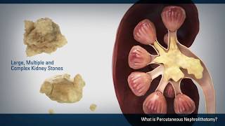 Percutaneous Nephrolithotomy PCNL [upl. by Hniht]