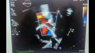 Based on this image what is the sonographer evaluating sp ASD [upl. by Meerak]