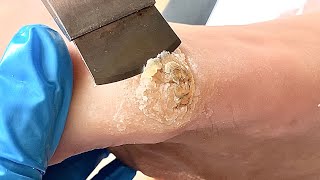 Callus removal from feetampFoot scraping dead skin【Xiao Yan pedicure】stress 46 [upl. by Bates982]