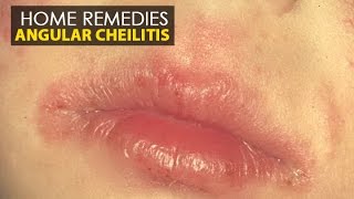 Angular Cheilitis  Home Remedies Natural Treatment  Health Education [upl. by Adlog]