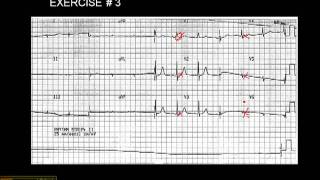 1215 Lead ECG Exercise  3 [upl. by Yedok105]