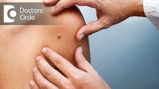 Is Laser wart removal effective for all types of warts  Dr Rajdeep Mysore [upl. by Airrehs693]