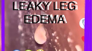 Leaky Leg Edema 3 months now Won’t stop HELP [upl. by Johnston]