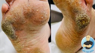 EXTRA THICK HARD SKIN REMOVAL TREATMENT CRAZY BIG CALLUS [upl. by Ecyt]