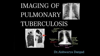 Imaging of pulmonary tuberculosis A detailed radiologic review  Checklist for reporting [upl. by Saloma]