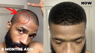 How to derma roll for thinning hairline and corners [upl. by Dey726]