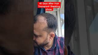 Day 45 After Hair Transplant  Shedding Phase besthairtransplant [upl. by Allison]