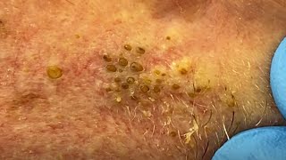 Extreme Blackhead Extraction Summer Throwback  CONTOUR DERMATOLOGY [upl. by Bond849]