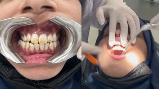 Step By Step Guide To Fluorosis Treatment  Dental Procedure Video [upl. by Wehttam887]