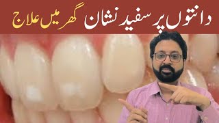 How to Remove White Spots on Teeth Home Remedies [upl. by Trudi221]