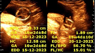 16 weeks 2 days pregnancy  Normal pregnancy [upl. by Tavey]